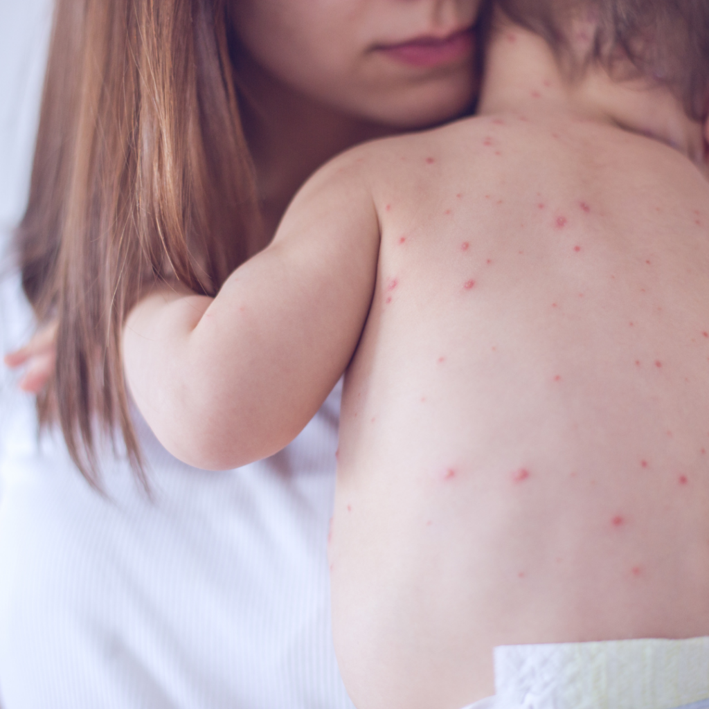 measles