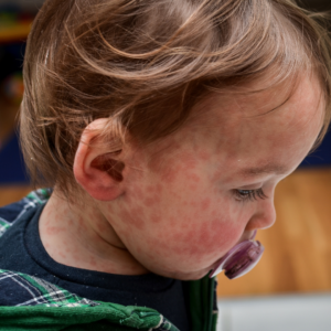 measles