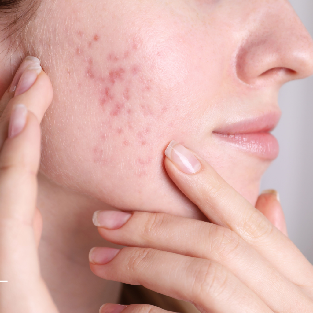 scar treatment