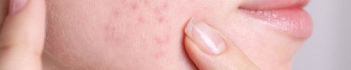 scar treatment