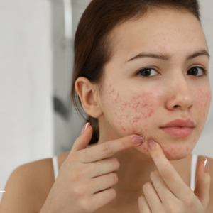 acne scars