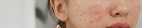 acne scars